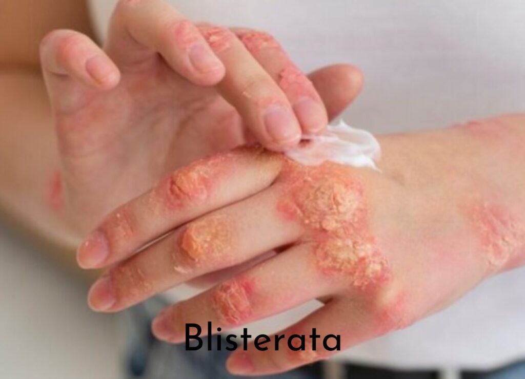 Blisterata