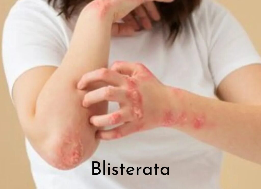 Blisterata